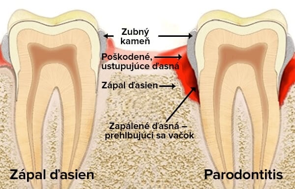 zapal_dasien_parodontoza
